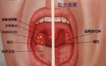 飞蚊症的治疗方法 治飞蚊症，扁桃体炎