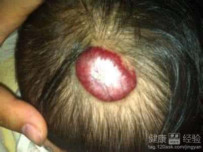 九香虫血管瘤 九香虫外涂方治疗血管瘤