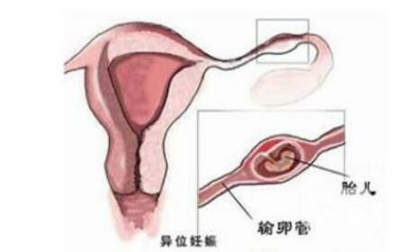 宫外孕会来月经吗 宫外孕会来月经吗 患上了宫外孕还会来月经吗