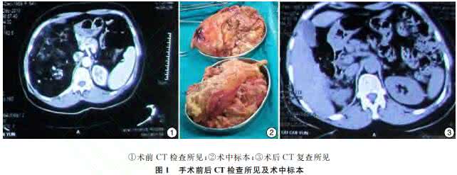 蚕豆病是什么遗传病 肾错构瘤是遗传病吗 肾错构瘤是什么病