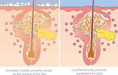 痤疮丙酸杆菌用什么药 痤疮杆菌 带你了解什么是痤疮杆菌