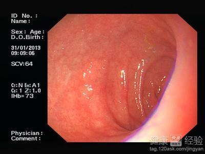 胃窦炎是什么症状 小儿胃窦炎的症状是什么？