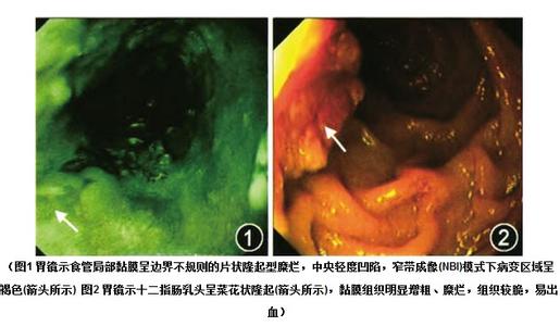 十二指肠乳头癌存活率 十二指肠乳头癌 十二指肠乳头癌怎么治疗