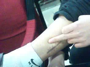 肝硬化病症 出现这些病症千万别硬扛