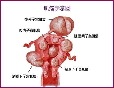 宫颈上有肌瘤怎么治疗 宫颈肌瘤 有宫颈肌瘤怎么办？