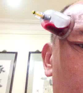 放血治病 放血治病 放血治病有效，但不能“被神化”