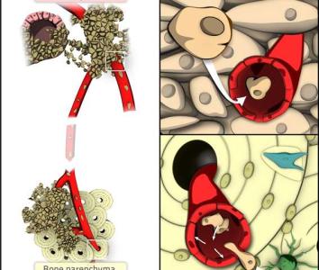 乳腺癌骨转移吃什么 乳腺癌骨转移 什么是乳腺癌骨转移