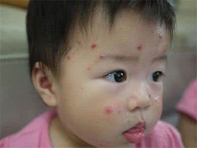 水痘的症状和预防措施 水痘症状 儿童如何预防水痘