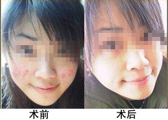 彩光祛痘 复合彩光祛痘是什么 有用吗