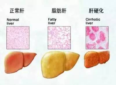 肝癌的早期信号 七症状或是肝癌信号