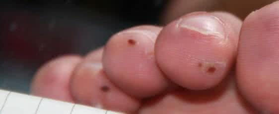 黑色素瘤转移能活多久 黑色素瘤能治愈吗?会转移吗?