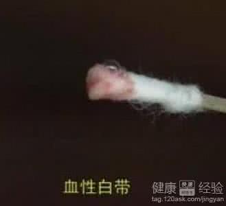 白带异常是什么症状 白带异常是什么症状 白带异常有哪些典型症状
