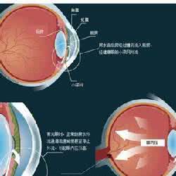 青光眼失明能治好吗 急性青光眼容易造成失明吗