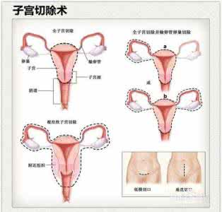 子宫切除术后食谱 子宫切除术后食谱是怎样的