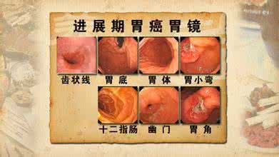 胃癌的治疗方法 胃癌的治疗 胃癌的治疗方法是什么样的