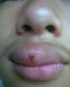 嘴唇为什么会肿 为什么我的嘴唇会肿?