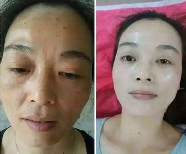 用什么方法可以去色斑 用什么方法可以去色斑 这样的方法可以去色斑