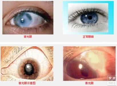 青光眼的类型 青光眼的症状 青光眼的不同类型及症状