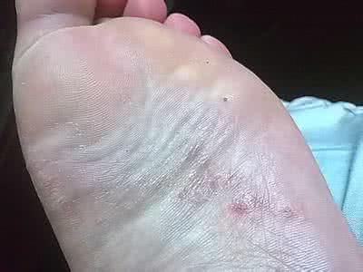 脚底痒是怎么回事 老是脚底痒是怎么回事？