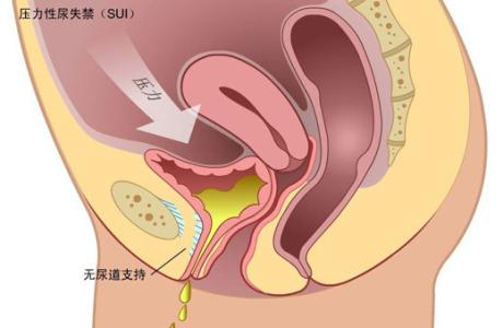 松弛 松驰 产后阴道松弛如何恢复 产后如何恢复阴道松驰