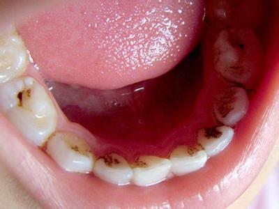 有虫牙怎么办 好多虫牙怎么办？