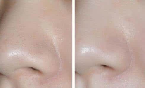 挤黑头 惊呆！黑头一挤一大片，怪我知道的太晚了