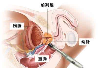 白点的发病原因有哪些 前列腺病的原因 前列腺病的发病原因有哪些