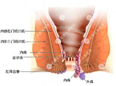 痔疮外痔的疗法 痔疗法--外痔