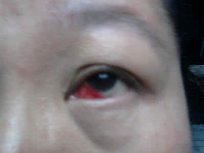 眼角膜出血 眼角膜出血 患上它应该怎么治疗