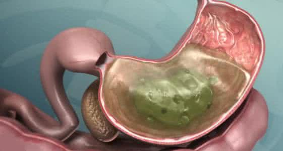 胃癌患者吃什么营养品 早上吃2颗它一辈子不患胃癌