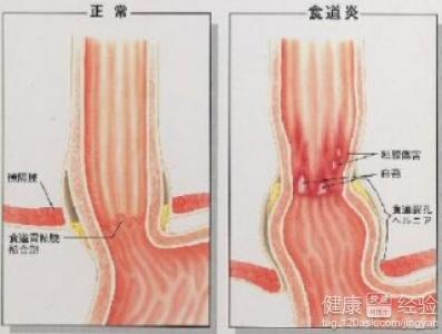 反流食道炎秘方 图文：治食道炎秘方