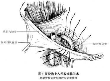 女性股疝是什么引起的 股疝的病因 股疝是如何引起的