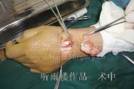 腱鞘囊肿手术多少钱 腱鞘囊肿做手术多少钱 囊肿做了手术会好吗？