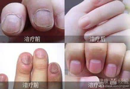 灰指甲怎么治疗方法 自己怎么治疗灰指甲 自己治疗灰指甲的方法