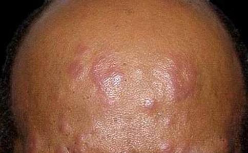 麻风病症状 结核样型麻风 结核样型麻风的症状有哪些_麻风病症状