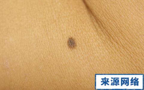 恶性黑痣 恶性黑痣 日媒教你辨别良恶性黑痣