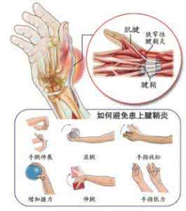 治腱鞘炎的三个小偏方 腱鞘炎偏方