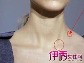 颈部淋巴癌早期症状 颈部淋巴癌早期症状 颈部淋巴癌如何治疗