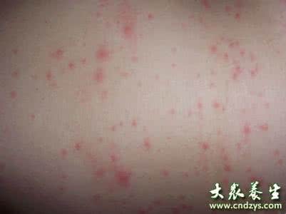 治疗慢性荨麻疹的偏方 慢性荨麻疹偏方 慢性荨麻疹的治疗