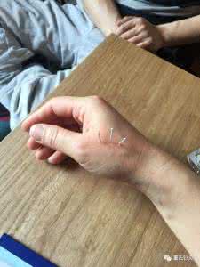 董氏针灸1一90集视频 董氏针灸治疗孕吐、产后哺乳、催奶、月子病等案例分享!