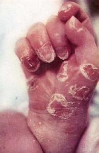 女人出轨不承认的表现 性病的表现 女人得了性病有什么表现