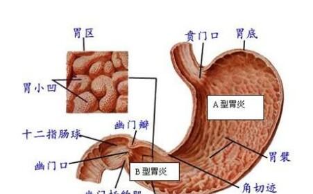 胃炎有哪些症状表现 胃炎的症状有哪些 正确区分胃炎