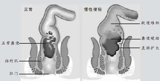 腹部左侧肠子硬 左腹肠子很硬 便秘 便秘的原因 便秘40年肠子竟变成这样子