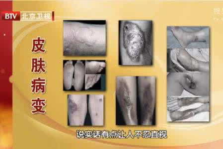 从中医角度看糖尿病 从细胞学角度看糖尿病