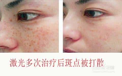 雀斑激光治疗 激光治疗雀斑有用吗？