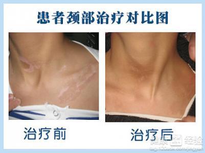 引起霍乱的主要因素是 引起白癜风的主要因素是什么？