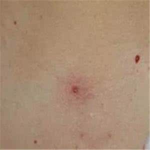 什么是蜘蛛痣图片 什么是蜘蛛痣 什么是蜘蛛痣?点痣的危害有哪些?