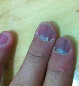 指甲变白是什么原因 指甲发紫是什么原因
