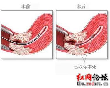 做流产危险吗 做流产危险么 某些止痛药增加女性的流产危险