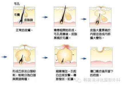 痤疮粉刺的治疗方法 粉刺是什么样 有哪些方法可以治疗